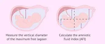 Asmniotic Fluid Assessment: MVP vs AFI, Borderline Findings, and Pitfalls